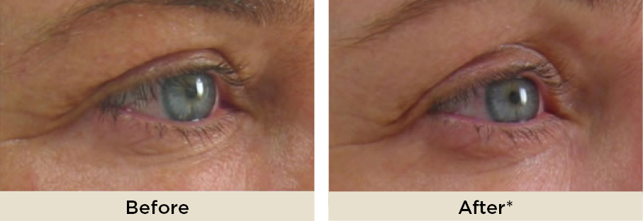 DrRakus_ultherapy_beforeafter11.jpg