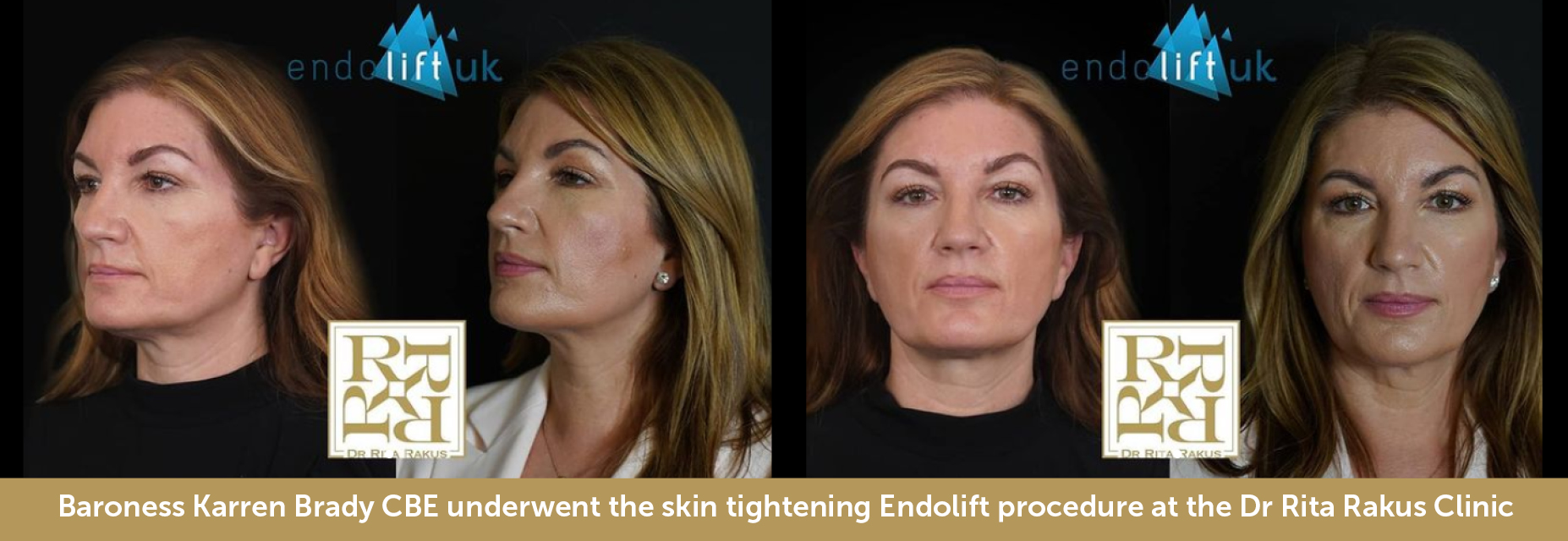 Endolift Dr Rita Rakus Clinic London 2289