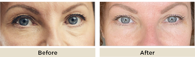 B&A_thumbnail_sylfirm_eye2.jpg