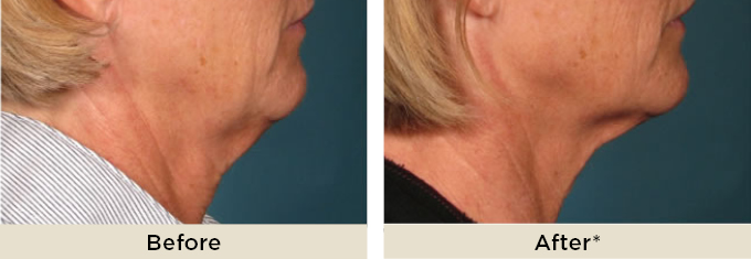 Non Surgical Face And Neck Lift Treatments | Dr Rita Rakus London