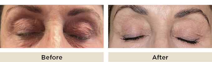 B&A_thumbnail_sylfirm_eye.jpg